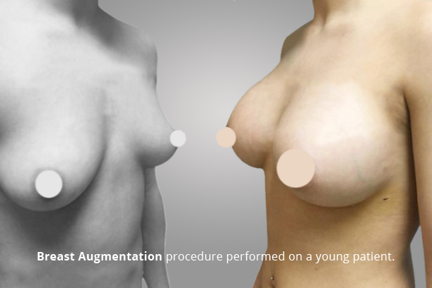 BREAST AUGMENTATION PROCEDURE PERFORMED ON A YOUNG PATIENT.