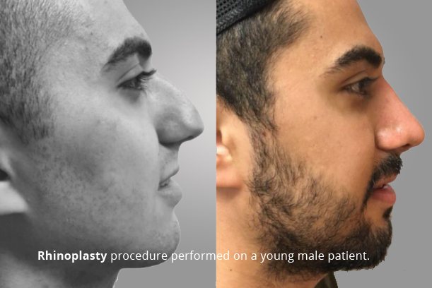 RHINOPLASTY PROCEDURE PERFORMED ON A YOUNG MALE PATIENT.