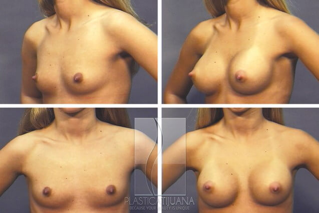 breastAugmentation2a54ef