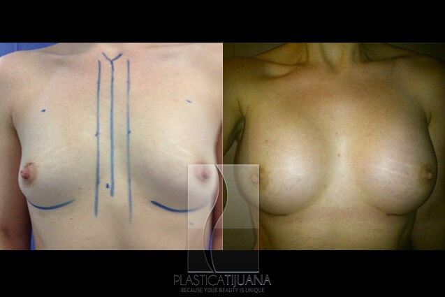 breastAugmentation3a54ef