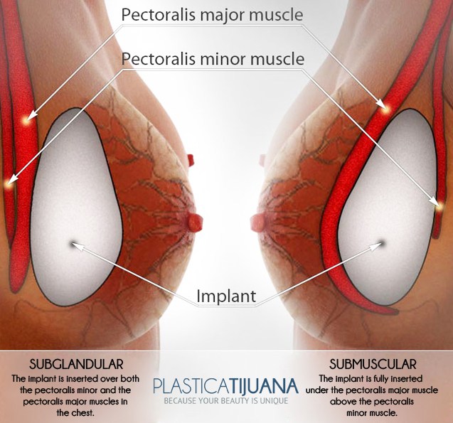 Breast Implants  Plástica Tijuana, Body Procedures
