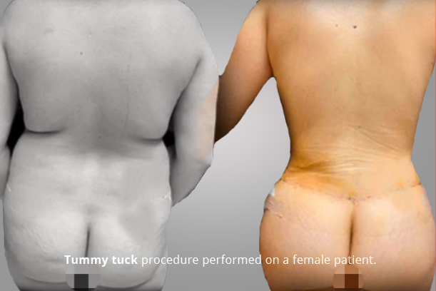 TUMMY TUCK PROCEDURE PERFORMED ON A FEMALE PATIENT.