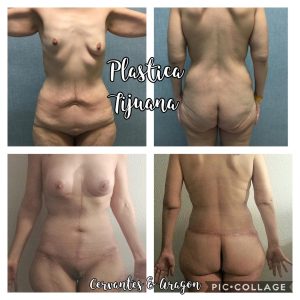 MOMMY MAKEOVER WITH BREAST REDUCTION