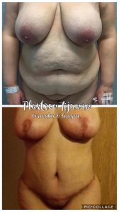 MOMMY MAKEOVER WITH BREAST REDUCTION